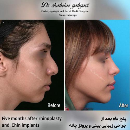 جراحی-بینی-592