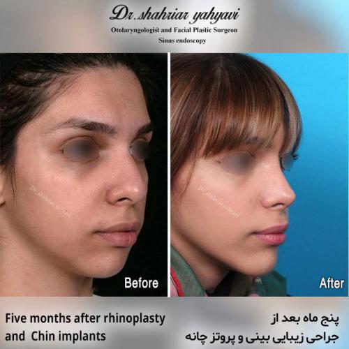 جراحی-بینی-593