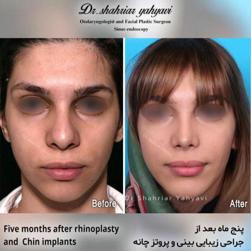 جراحی-بینی-594