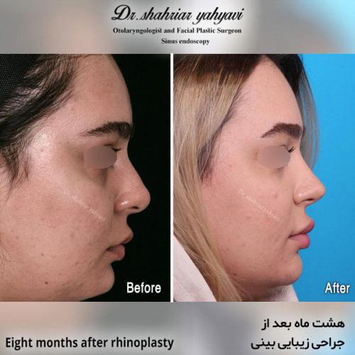 جراحی-بینی-595