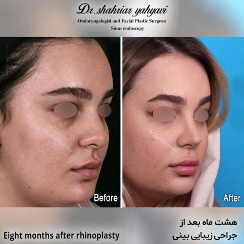 جراحی-بینی-596