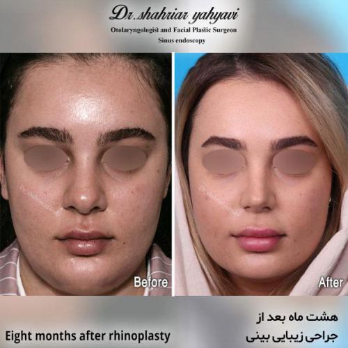 جراحی-بینی-597