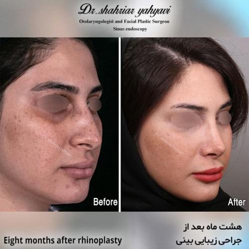 جراحی-بینی-598