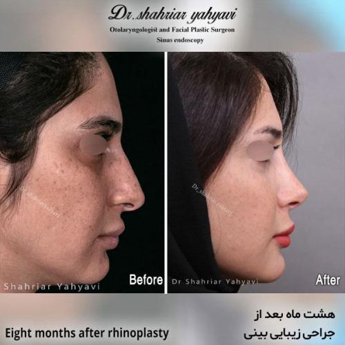 جراحی-بینی-599