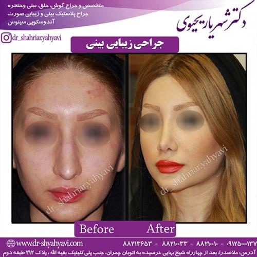 جراحی-بینی-60