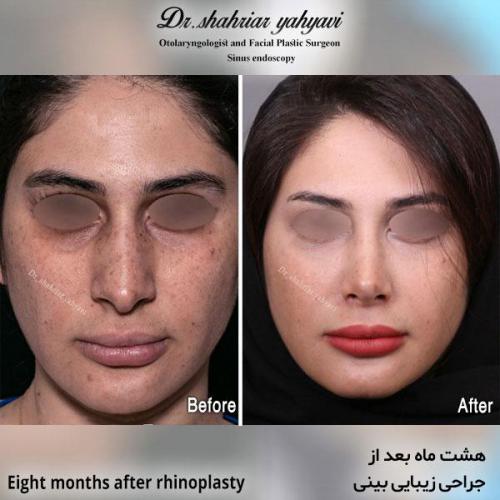 جراحی-بینی-600