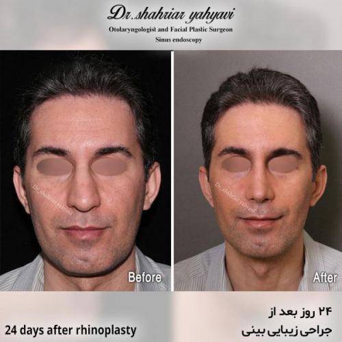 جراحی-بینی-601
