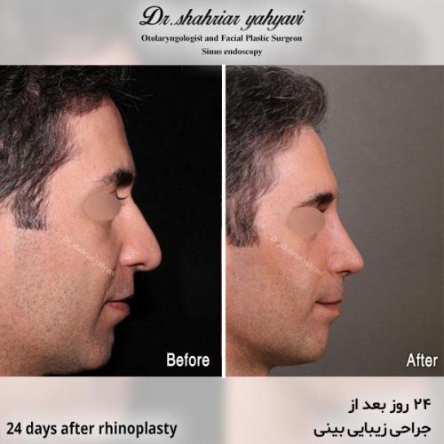 جراحی-بینی-602