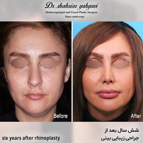 جراحی-بینی-603