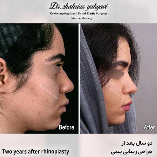 جراحی-بینی-605
