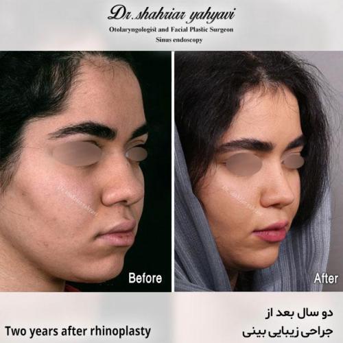 جراحی-بینی-606