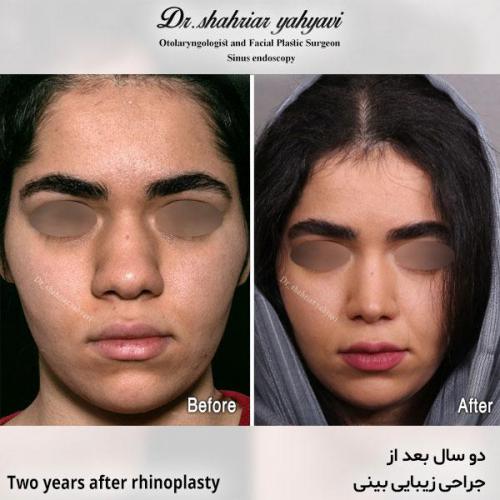 جراحی-بینی-607