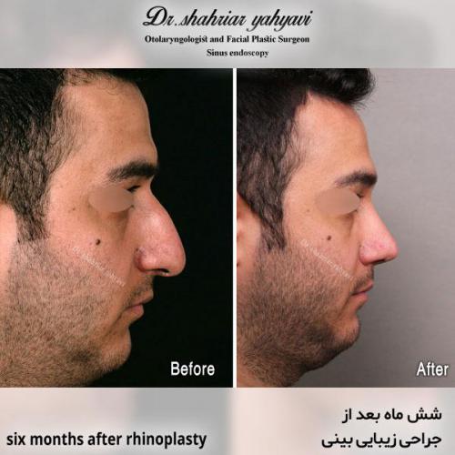 جراحی-بینی-608