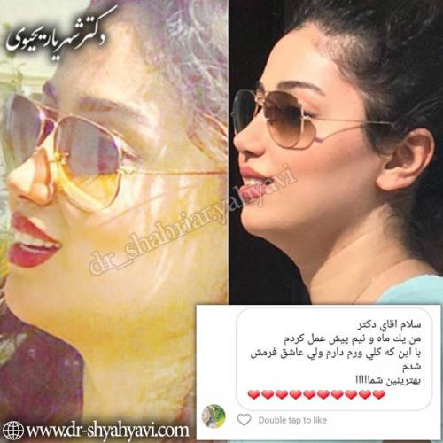 جراحی-بینی-61