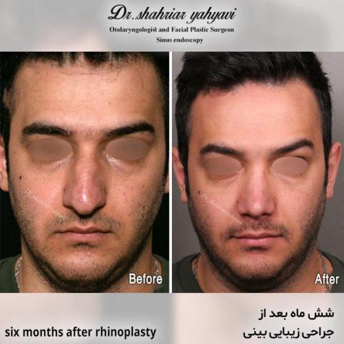 جراحی-بینی-610