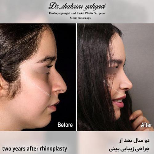 جراحی-بینی-611