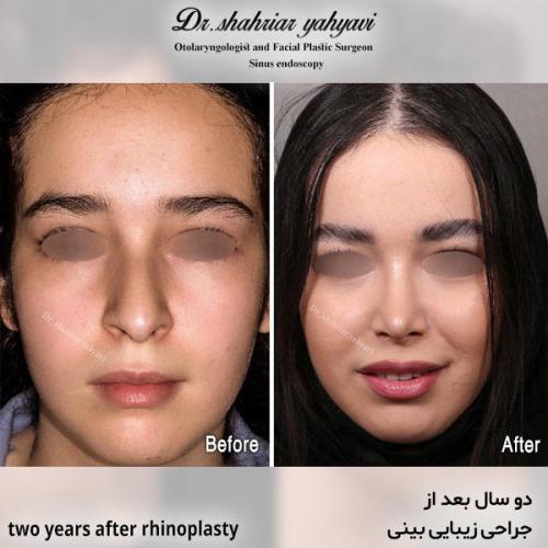 جراحی-بینی-612