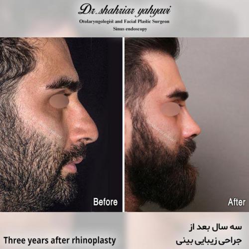 جراحی-بینی-613