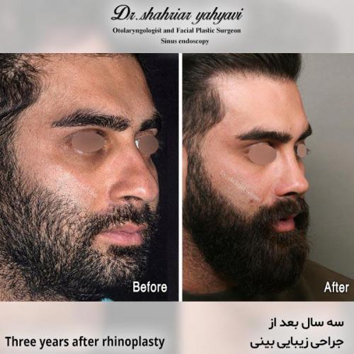 جراحی-بینی-614