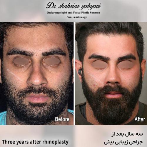 جراحی-بینی-615