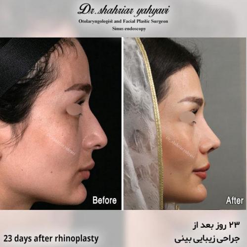 جراحی-بینی-617