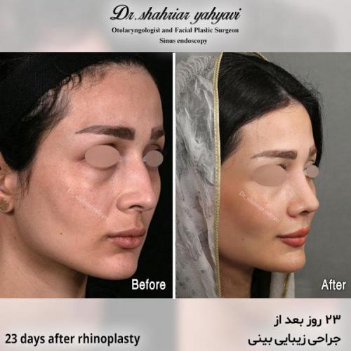 جراحی-بینی-618