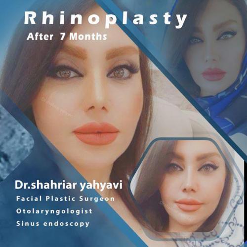 جراحی-بینی-619
