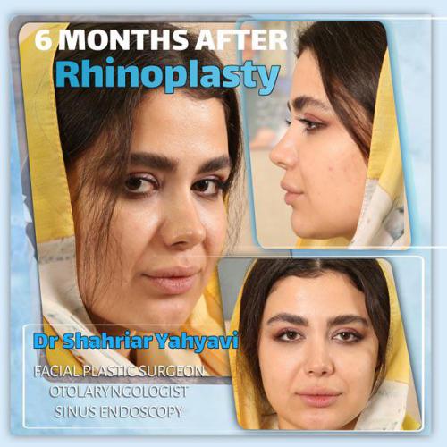 جراحی-بینی-620