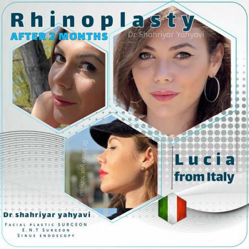 جراحی-بینی-622