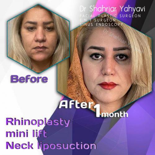 جراحی-بینی-625