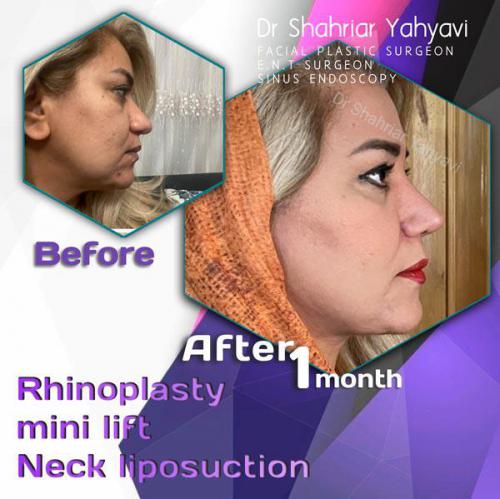 جراحی-بینی-626