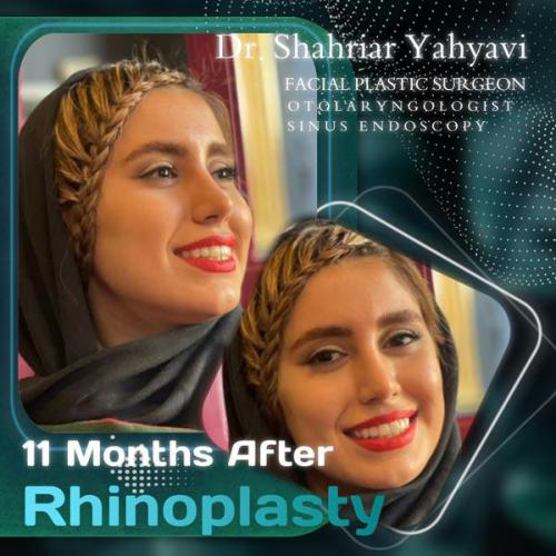 جراحی-بینی-627