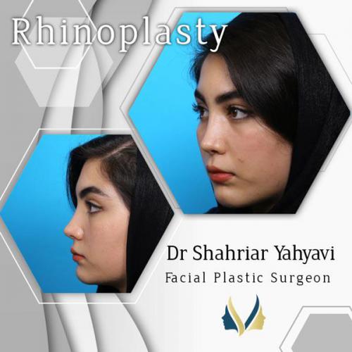 جراحی-بینی-628 (1)