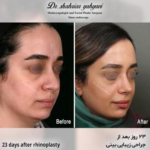 جراحی-بینی-629