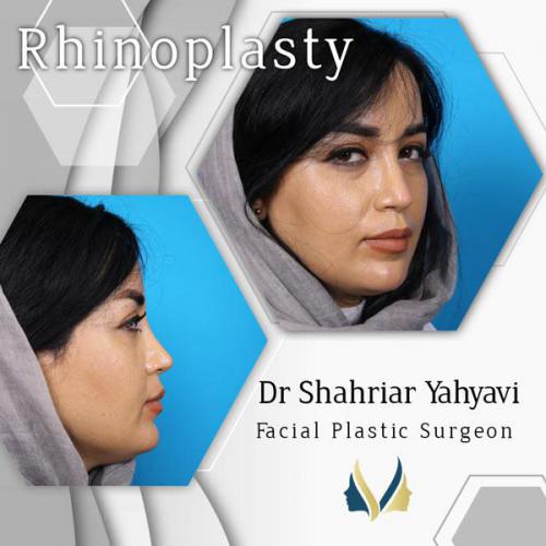 جراحی-بینی-629 (1)