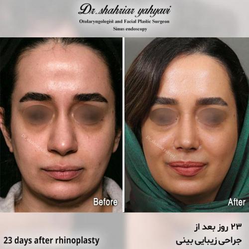 جراحی-بینی-630