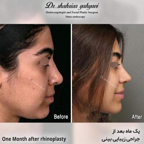 جراحی-بینی-631