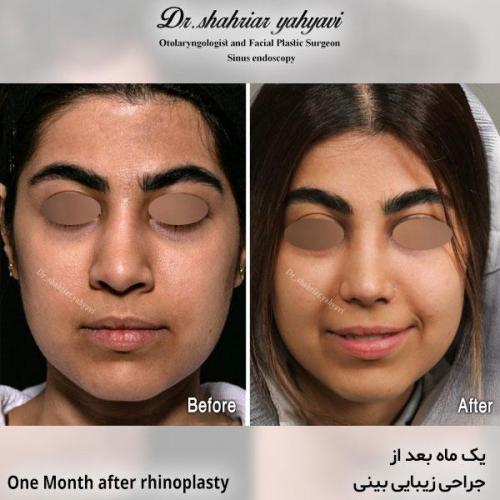 جراحی-بینی-633