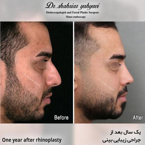 جراحی-بینی-634