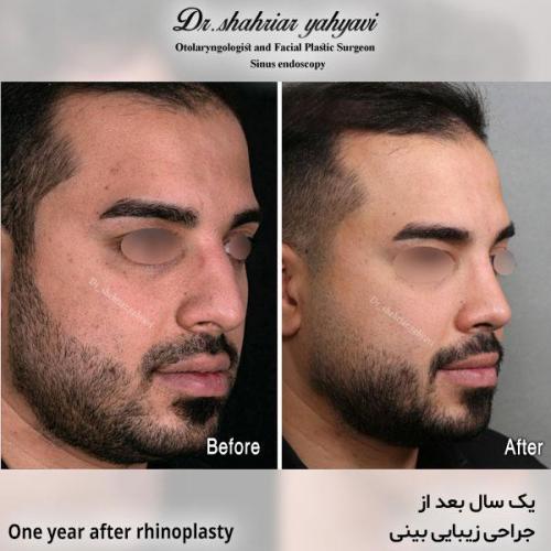 جراحی-بینی-635