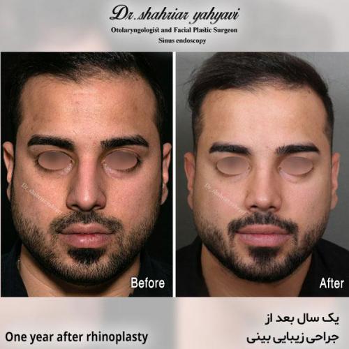 جراحی-بینی-636