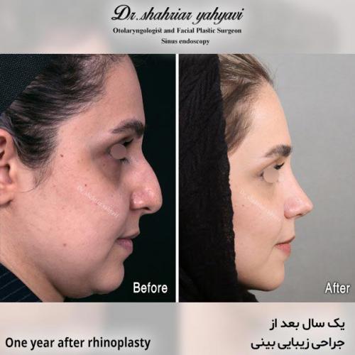 جراحی-بینی-637