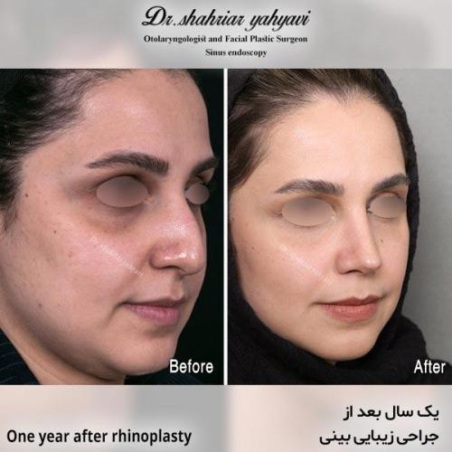 جراحی-بینی-638