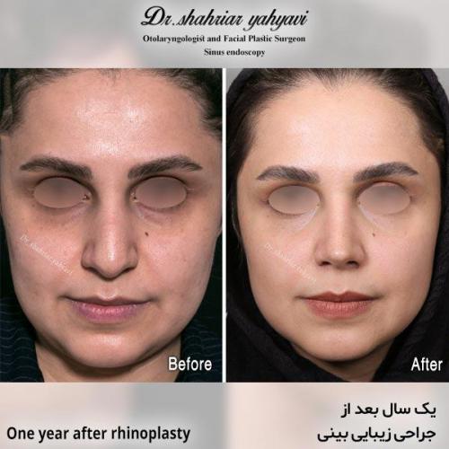 جراحی-بینی-639