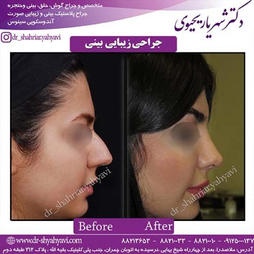 جراحی-بینی-64