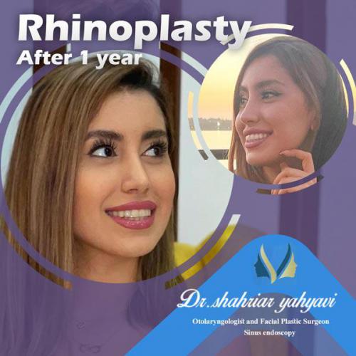 جراحی-بینی-641