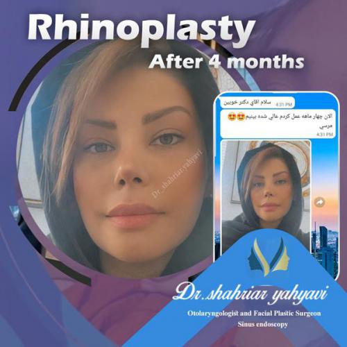 جراحی-بینی-642