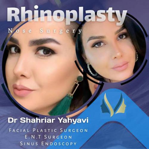 جراحی-بینی-644