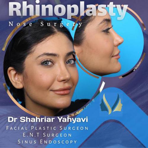 جراحی-بینی-645