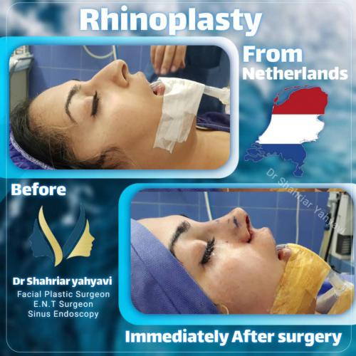 جراحی-بینی-646